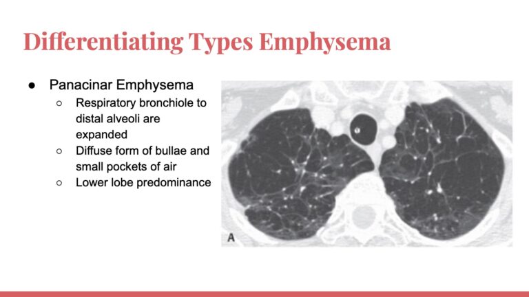 Radiology Presentation- Emphysema Imaging – Jordan Villaruel