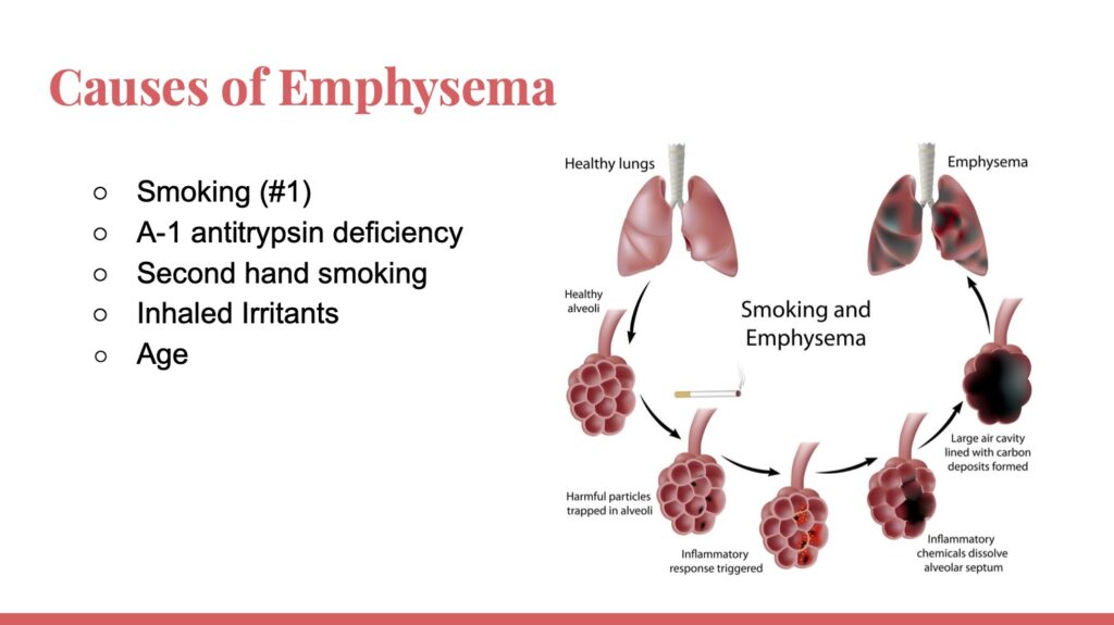 Radiology Presentation- Emphysema Imaging – Jordan Villaruel